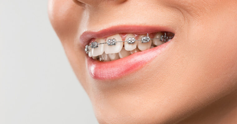 Брекеты Dental Studio Черкассы